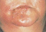 帯状疱疹.jpg
