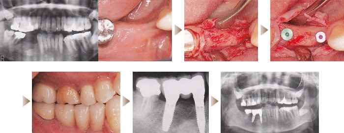 インプラント症例