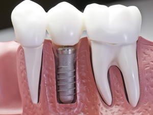 インプラントの最大のメリットは、天然歯に近い噛み心地